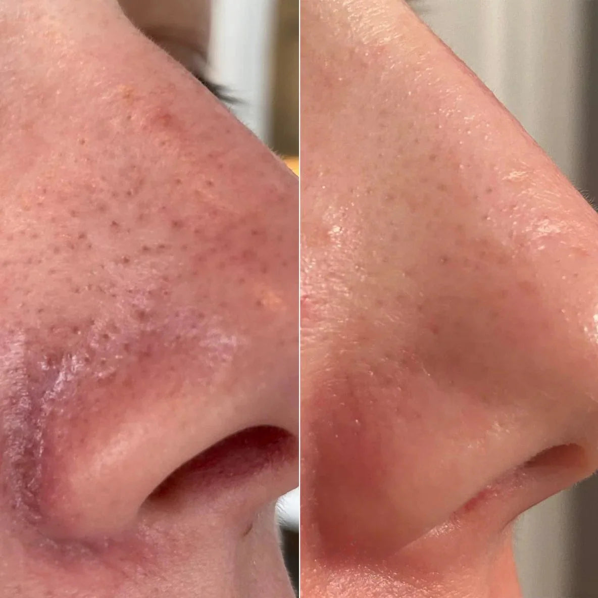 Before and after results using Rice Peel Shot treatment